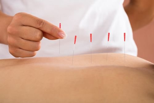שירותי דיקור סיני בחיפה, למי זה מתאים